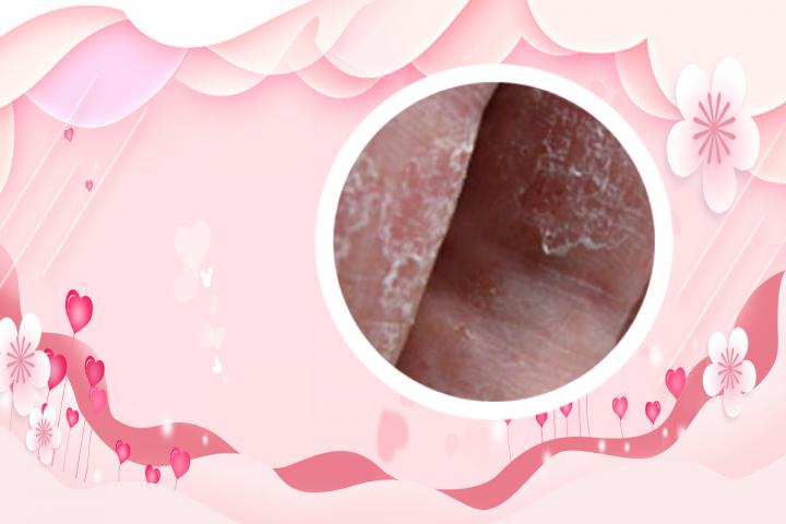 银屑病为什么多在毛发里