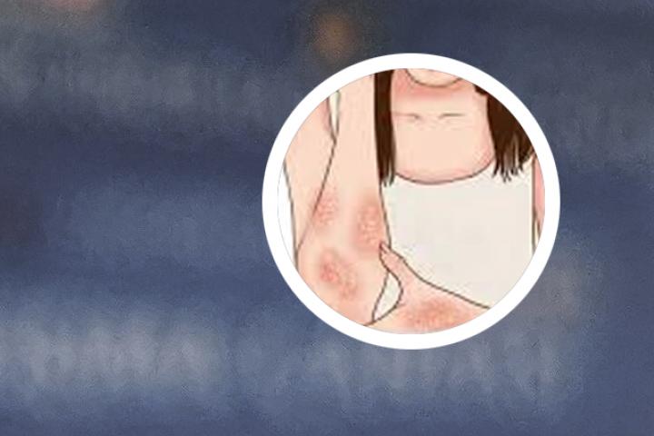 银屑病美国