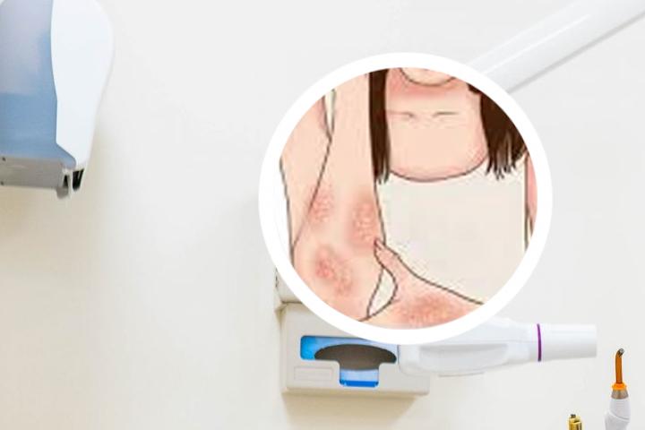 13岁男孩银屑病治疗
