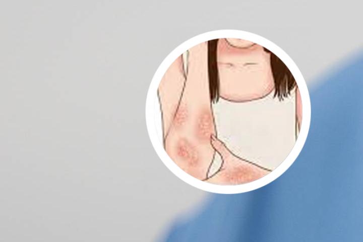 纯中医治疗牛皮癣信息