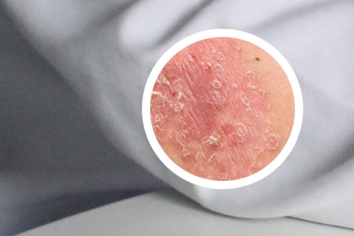 牛皮癣和录豆汤管用吗