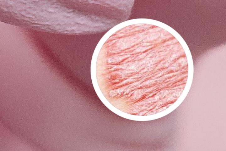 手指头上长了块牛皮癣