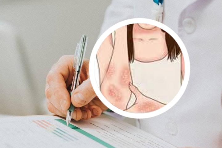 银屑病严重后会转成什么病