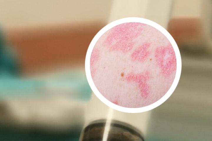 芙药师可以治银屑病