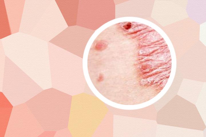 银屑病pso全拼