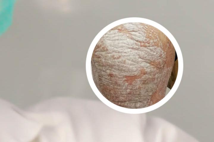 狗树汁治疗牛皮癣