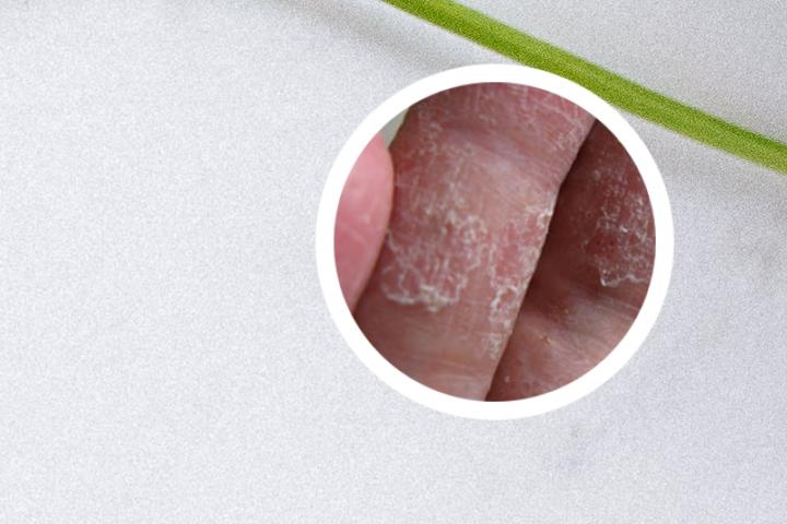 治疗银屑病的创新药有哪些