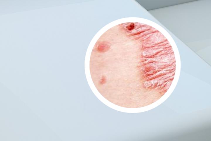 内蒙古红皮病型银屑病有什么症状和治疗方法吗
