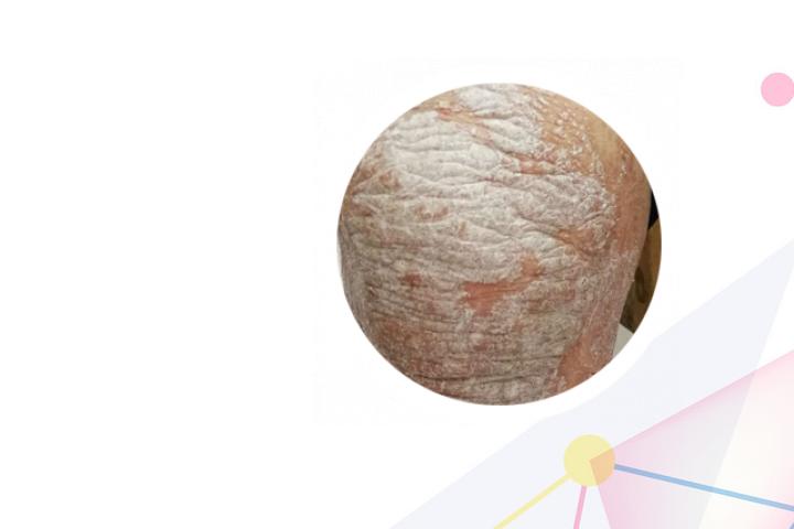 牛皮癣的费用是多少钱