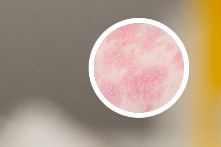 日照治疗银屑病祖传方法