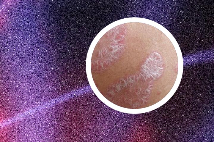 轻微银屑病药物治疗