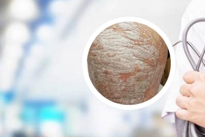 牛皮癣中药自制