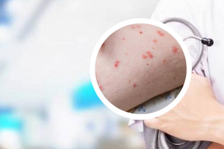 银屑病的症状治疗