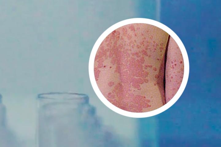 生物制剂牛皮癣病人