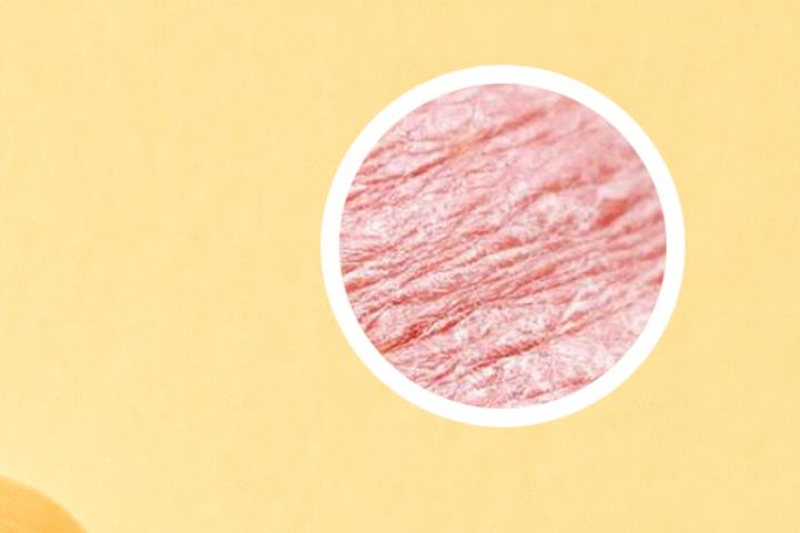 小孩子有银屑病