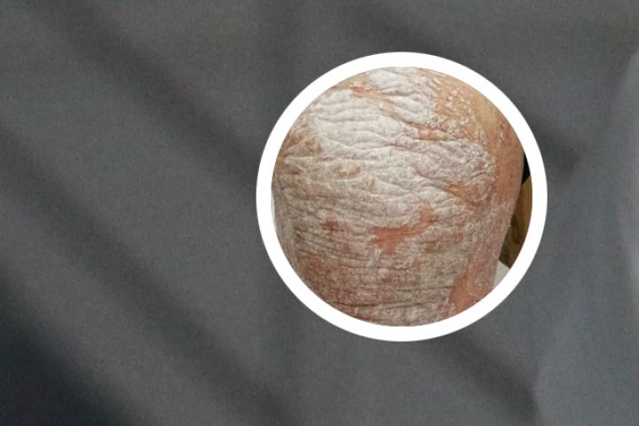 马拉色菌会诱发牛皮癣吗