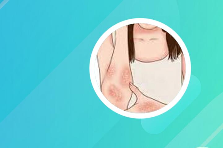 牛皮癣含有什么成分