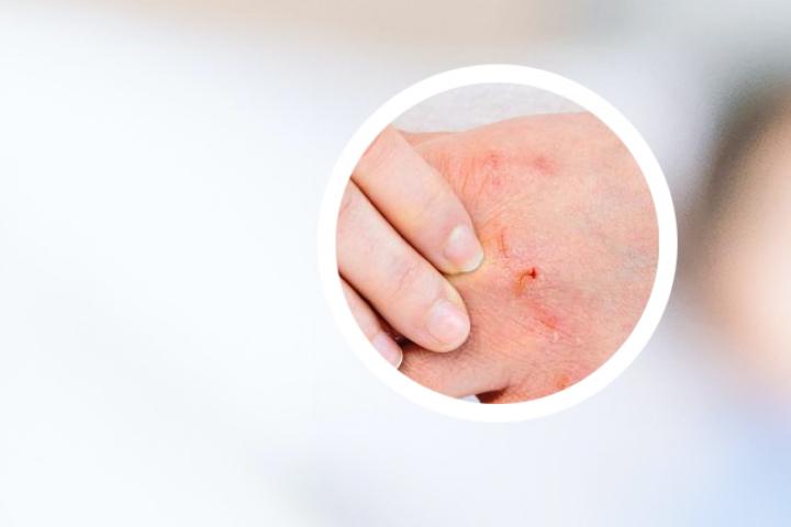 滴状银屑病传不传染