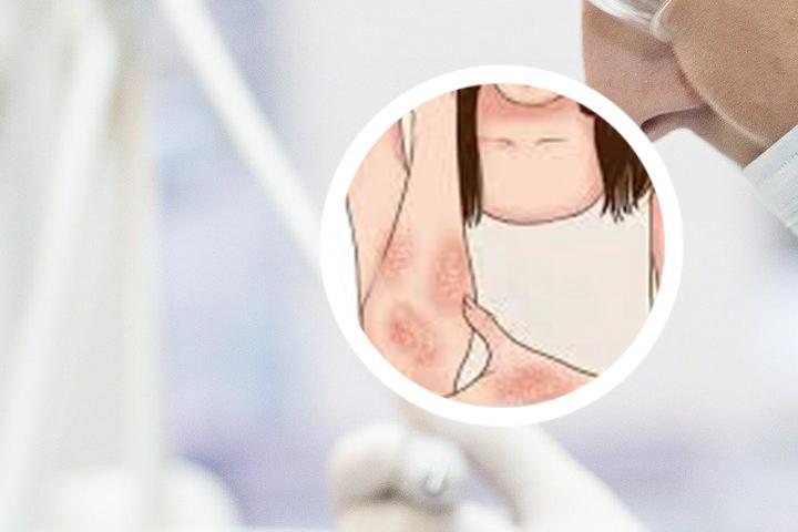 妈妈有牛皮癣可以母乳喂养吗
