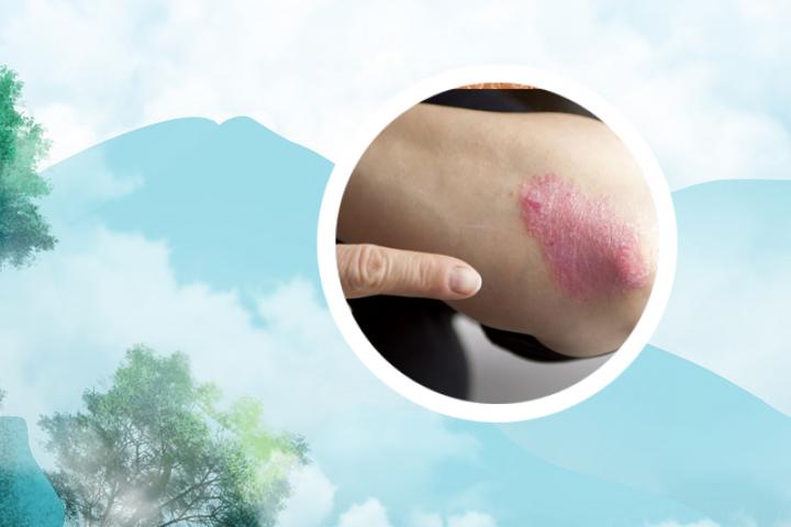 石景山中医院牛皮癣专科