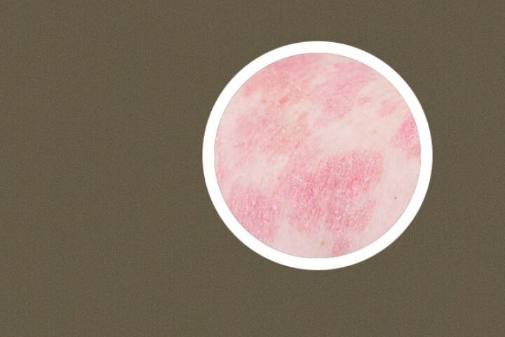 牛皮癣用什么液体敷料
