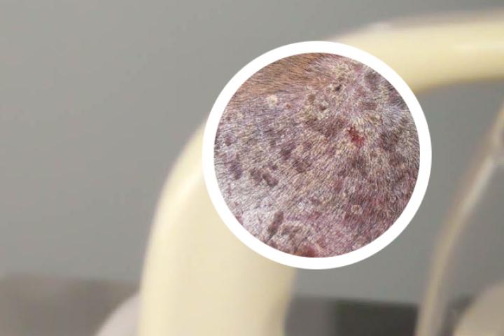 狼毒治好牛皮癣
