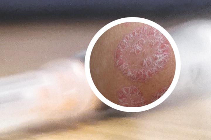 银屑病吃息斯敏