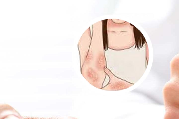 银屑病表面很烫怎么办