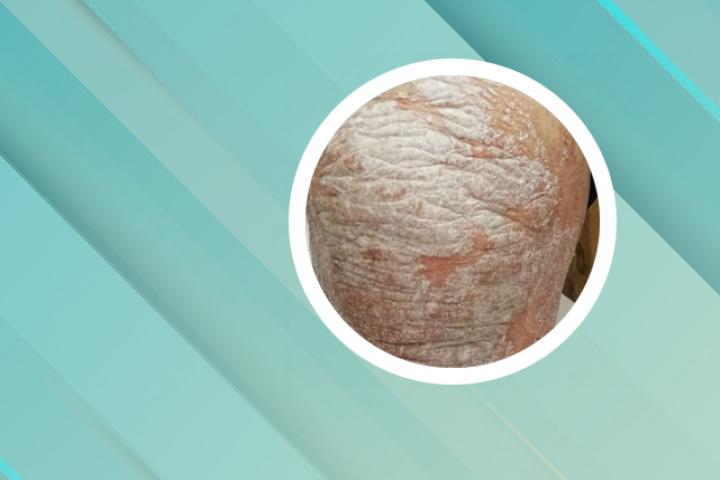 牛皮癣能吃腐竹不