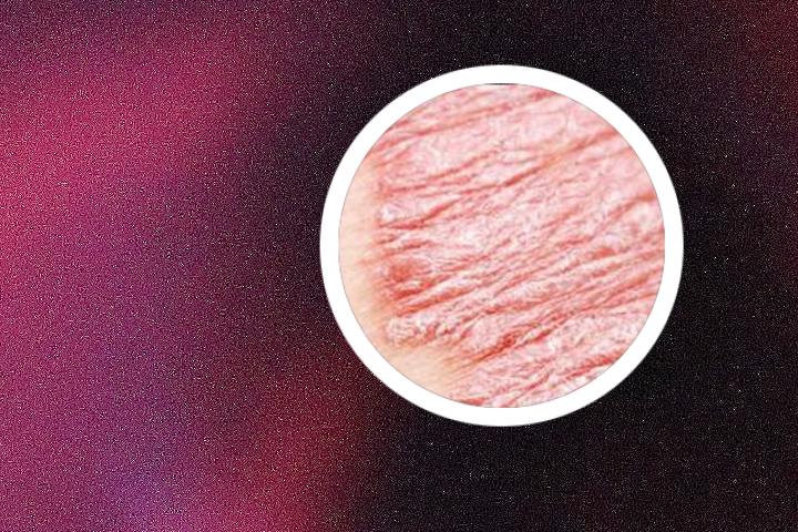 上海哪有冶疗银屑病的