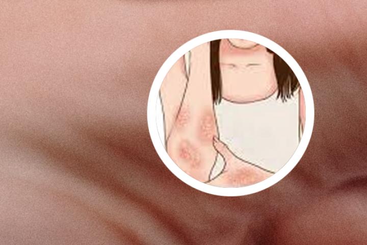 小黄膏治牛皮癣怎样