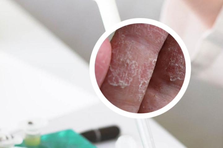 牛皮癣用完药颜色发黑