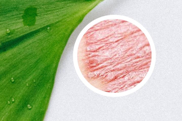 银屑病需终生用药吗