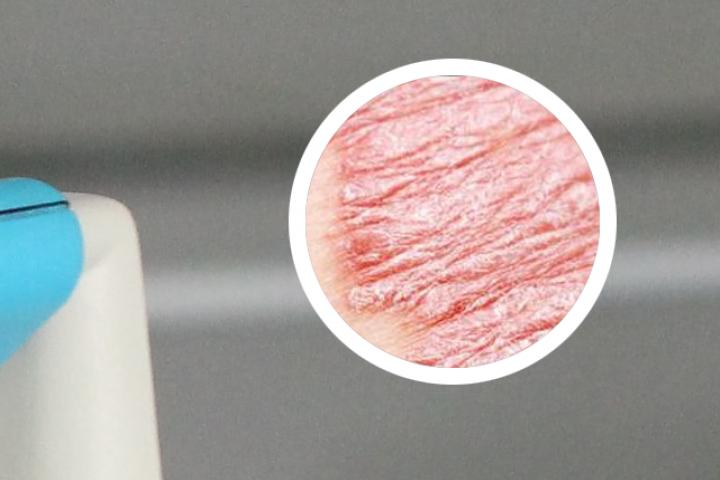 牛皮癣流黄水还能洗澡吗