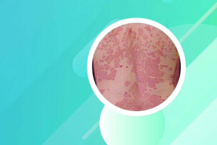 男性银屑病治疗方法