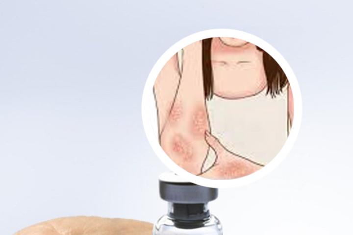 牛皮癣的皮疹特征
