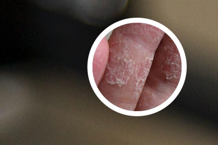 银屑病怎么治男性