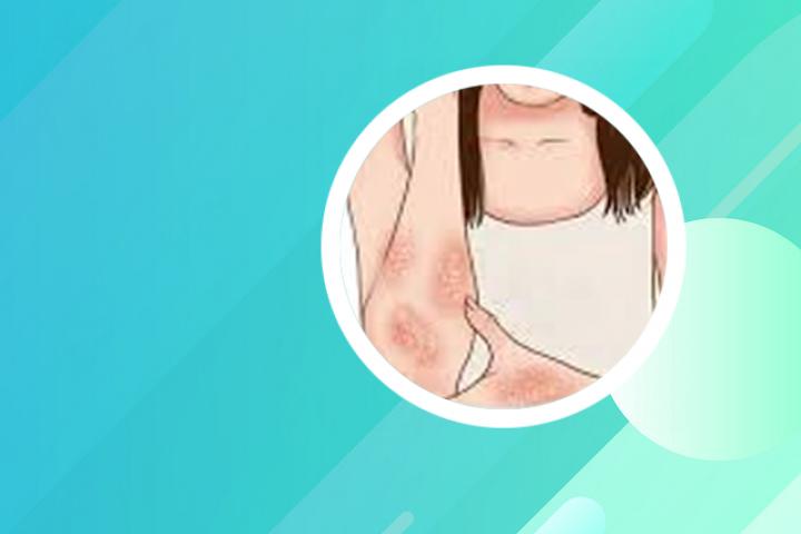 毛囊炎和牛皮癣的联系