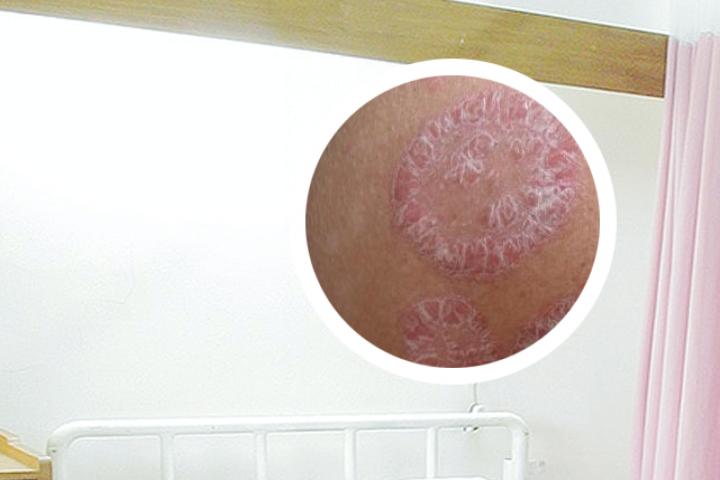 脚银屑病多了会肿吗