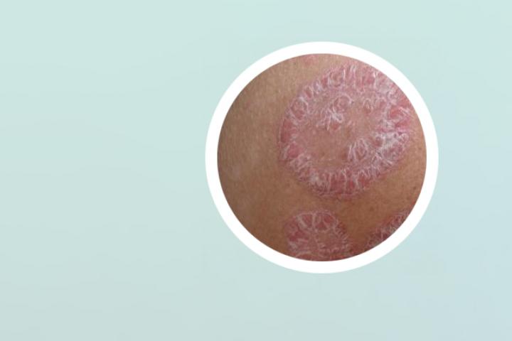 海水能治愈银屑病吗视频