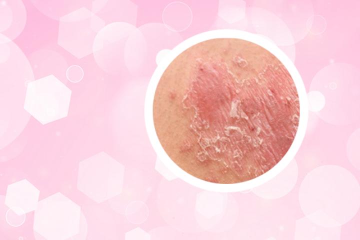 银屑病角化不全病理图