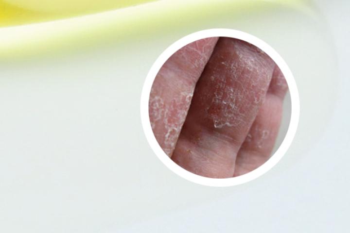 关节型银屑病是基础病嘛