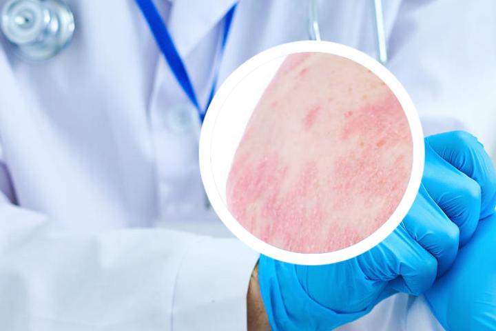银屑病生物制剂起效