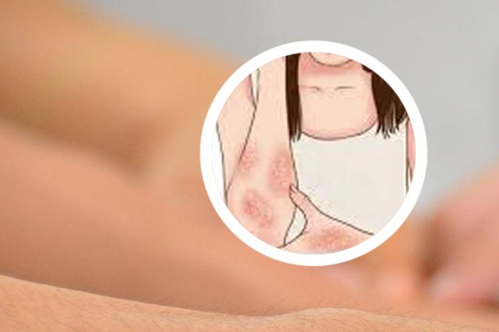 牛皮癣什么药可以去根