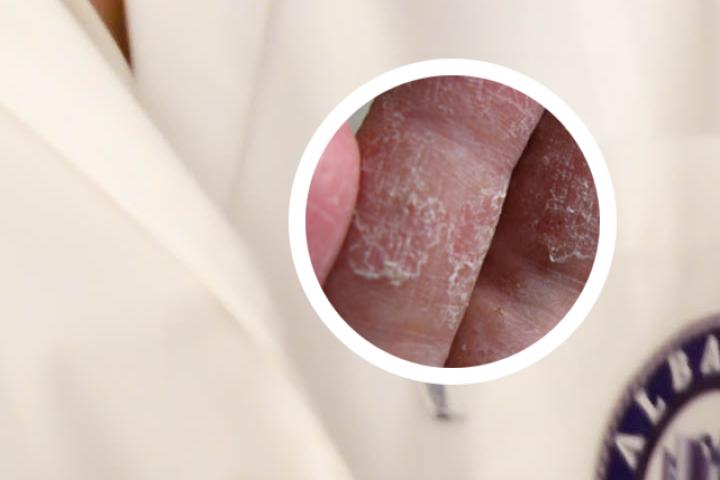 银屑病可以结婚吗