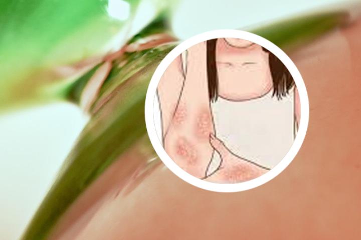 牛皮癣长满头了要剃头吗