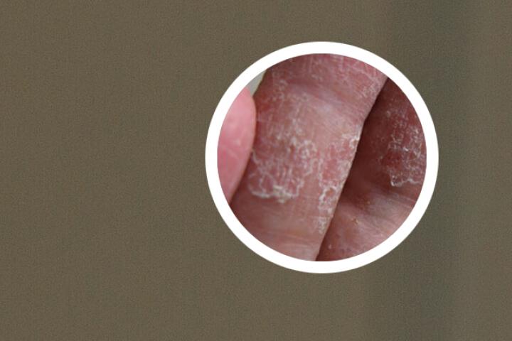 治疗银屑病用啥药