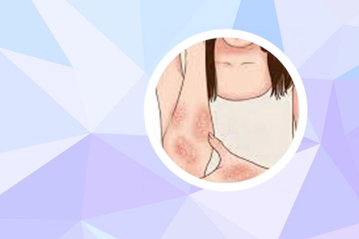 牛皮癣治愈后头疼怎么回事