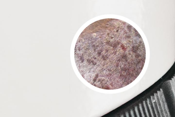 我的银屑病病理结果是什么