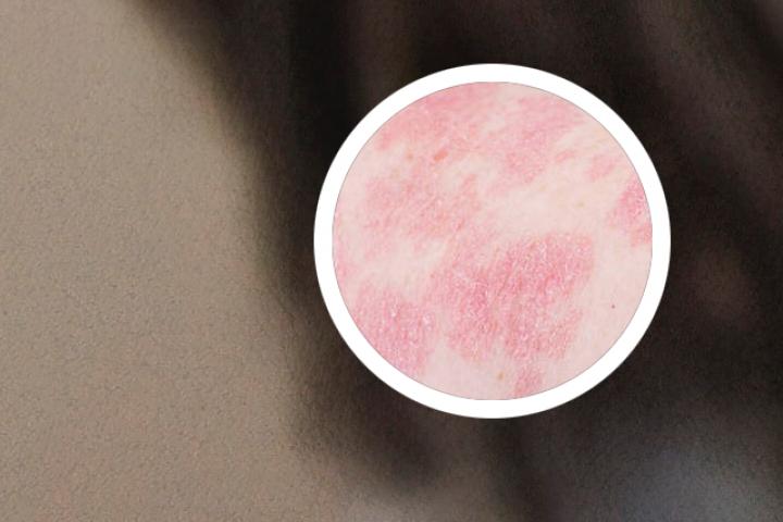 玉树牛皮癣